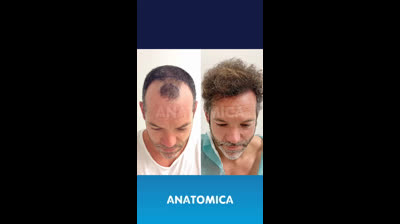 Hair transplantation Before & After Dominican Republic