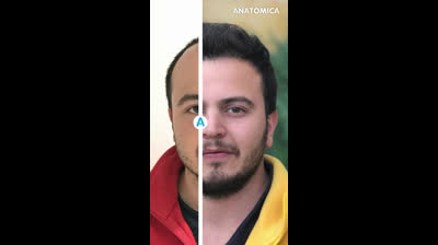 Trasplante Capilar  Antes & despues