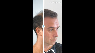 Add a new color to your life with anatomica hair transplantation